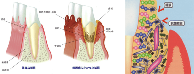 歯周病にかかった状態