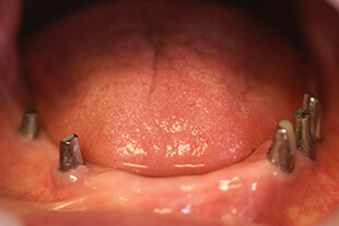 インプラント総入れ歯1