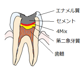 4Mix法