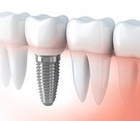 南アフリカの歯科インプラントコスト