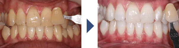 ホワイトニング症例
