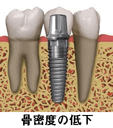 インプラント