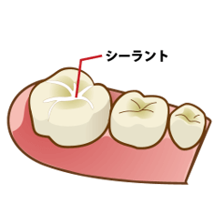 歯科医師にシーラントについて話す
