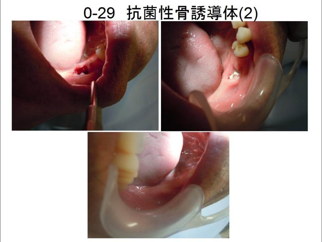 後 親知らず 抜歯